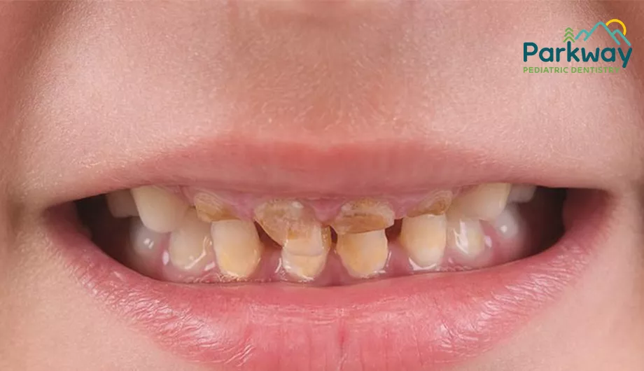 How Can One Best Prevent the Loss of Tooth Enamel?